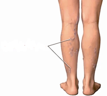 As a result of knee arthrosis