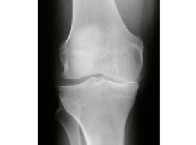 Diagnosis of knee joint arthrosis