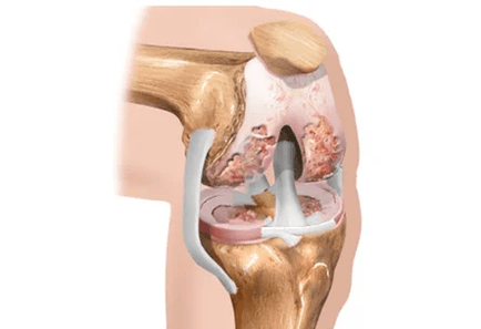 arthrosis or arthritis difference