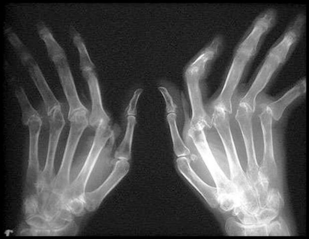 X -Groups of hand pictures affected by arthrosis