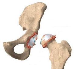 Causes -Development of hip joint arthrosis
