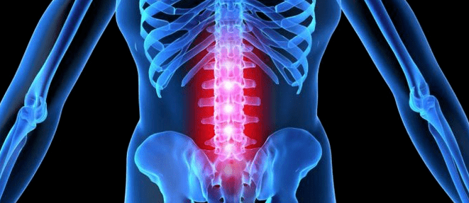 Deformation of an intervertebral disc