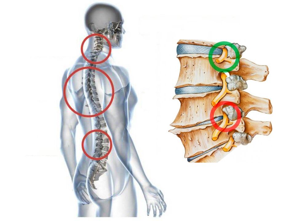 What is the cervical osteochondrosis of the vertebrae such as