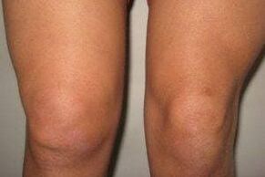 Inflammation in the knee joint with arthritis and arthrosis