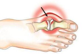 Joint damage due to arthritis and arthrosis