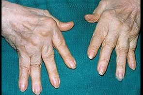 Symptoms of arthritis in the finger