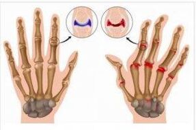 The difference between arthritis and hand arthrosis