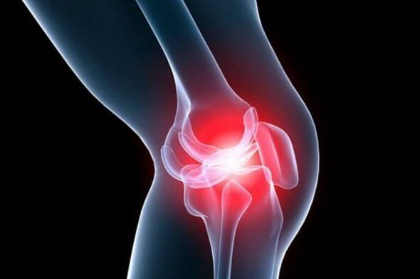 Arthrosis of the knee joint