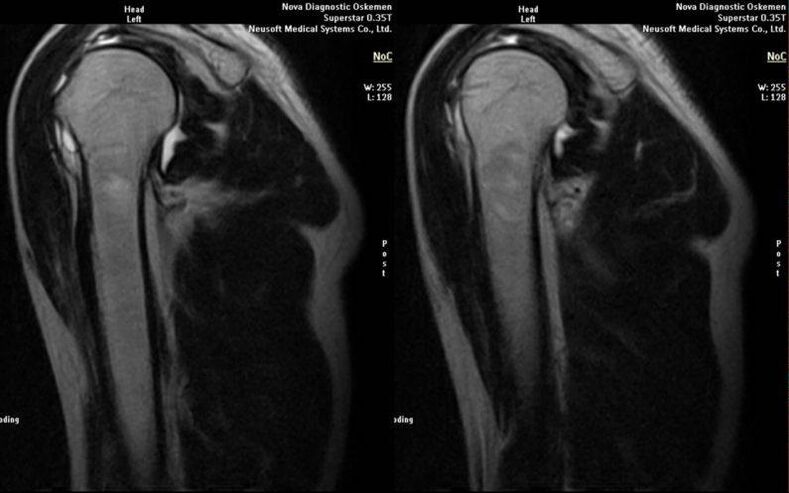 shoulder joint arthrosis on x-ray